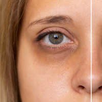 Göz altı morlukları için basit ve doğal tedavi yöntemleri