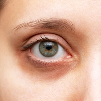 Göz Altı Morlukları Nedir, Neden Olur ve Nasıl Geçer?