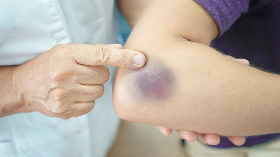 Morluk neden olur, nasıl geçer?