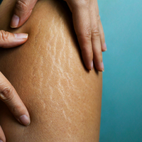 Selülit neden olur, nasıl geçer?