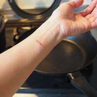 Yanık izi kalır mı ve nasıl geçer?