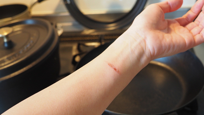 Yanık izi kalır mı ve nasıl geçer?