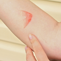 Yanık izine bitkisel ve doğal tedavi önerileri