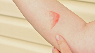 Yanık izine bitkisel ve doğal tedavi önerileri