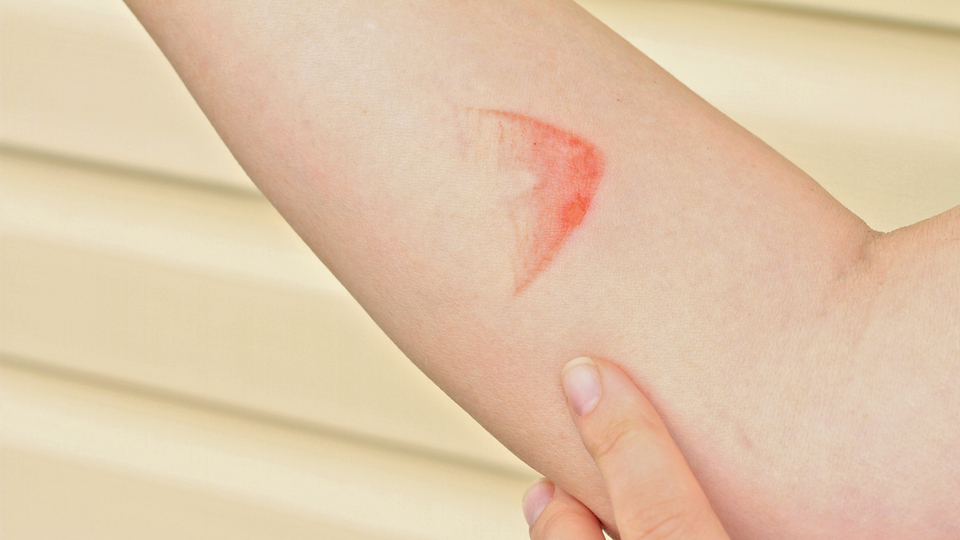 Yanık izine bitkisel ve doğal tedavi önerileri