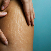 Yaz aylarının korkulu rüyası selülite iyi gelen şeyler