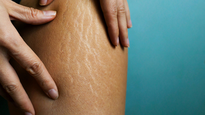 Yaz aylarının korkulu rüyası selülite iyi gelen şeyler