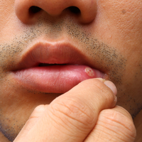 Aft nedir, neden olur ve nasıl geçer?