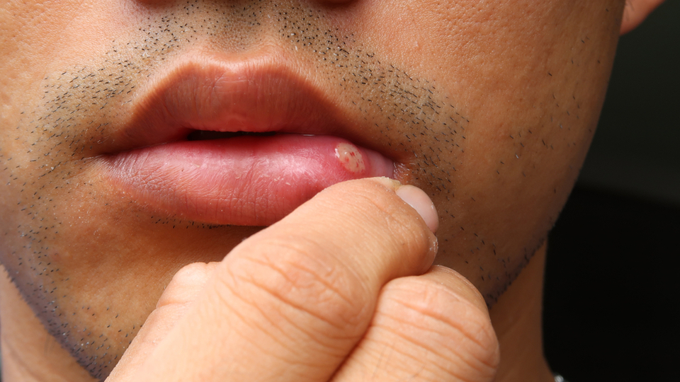 Aft nedir, neden olur ve nasıl geçer?