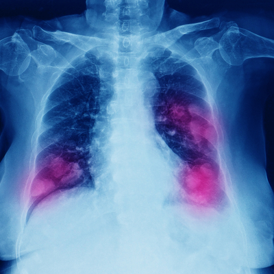 Gizemli zatürre alarmı!