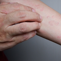 Kurdeşen dökmek neden olur?