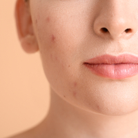 Sivilce lekeleri neden olur ve nasıl geçer?