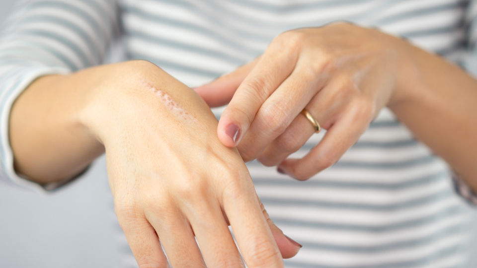 Yara izi nedir, neden olur ve nasıl geçer?