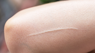 Yara izlerine iyi gelen doğal ve bitkisel çözümler