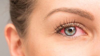 Göz kanlanması neden olur, nasıl geçer?