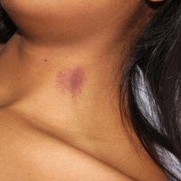 Boyun morluğu nasıl geçer?