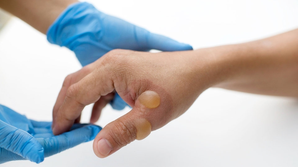 Su toplaması neden olur, nasıl geçer?