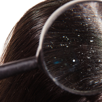 Saçtaki Kepek Neden Olur, nasıl geçer?