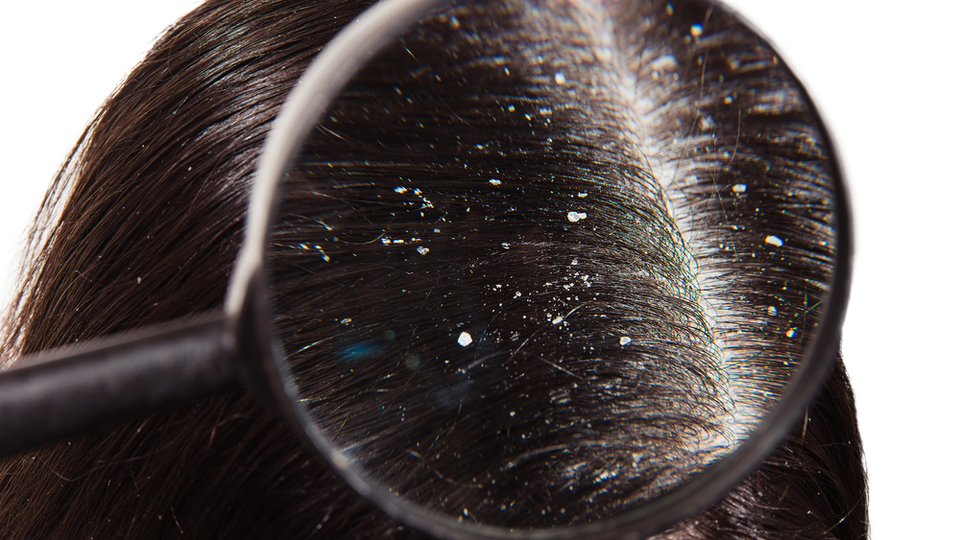 Saçtaki Kepek Neden Olur, nasıl geçer?