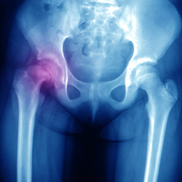 Doğuştan kalça çıkığı nedir ve nasıl anlaşılır?