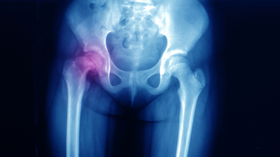 Doğuştan kalça çıkığı nedir ve nasıl anlaşılır?