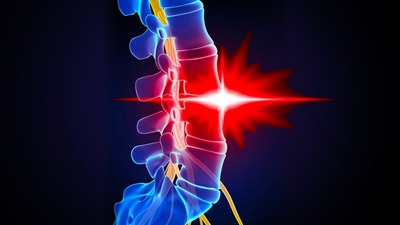 Bel fıtığınız olduğunu kesin olarak gösteriyor! İşte o 4 belirti