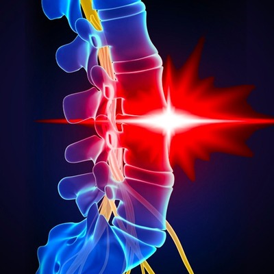 Bel fıtığınız olduğunu kesin olarak gösteriyor! İşte o 4 belirti