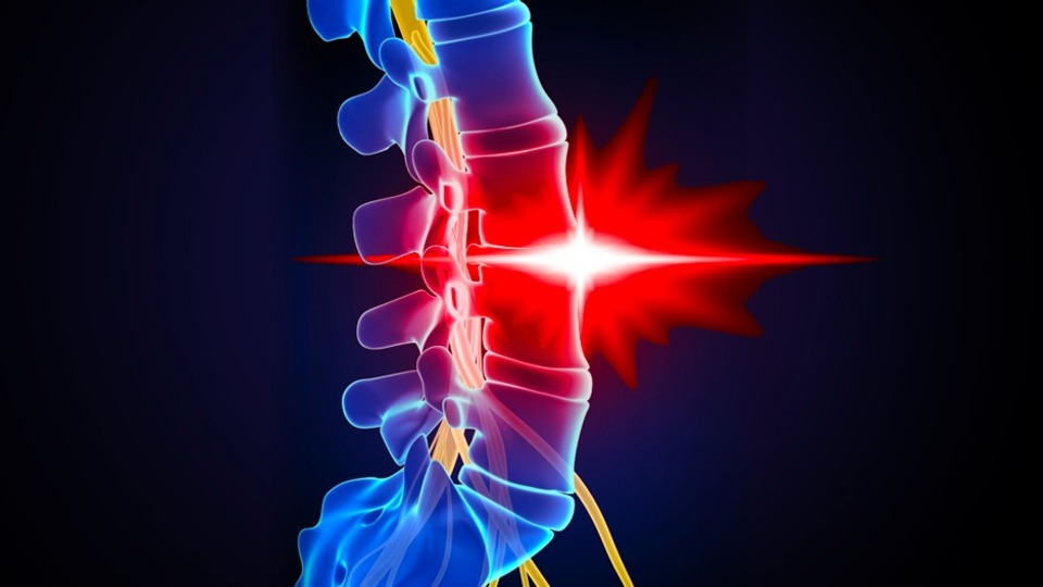 Bel fıtığınız olduğunu kesin olarak gösteriyor! İşte o 4 belirti