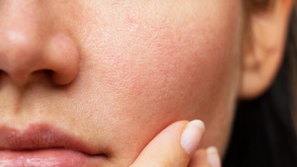 Yüzdeki benler neden çıkar, nasıl geçer?