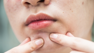 Yüzdeki yağ bezeleri neden olur, nasıl geçer?