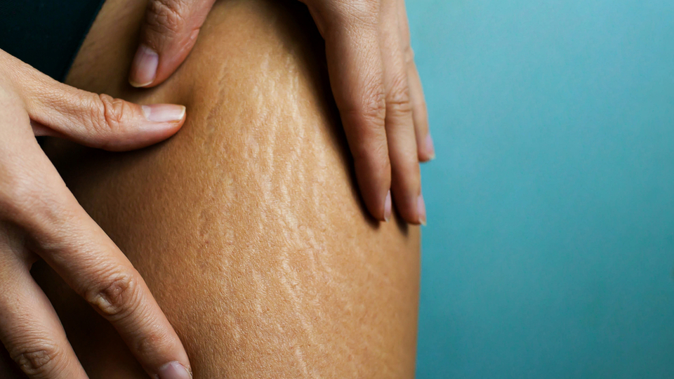 Vücut çatlaklarına iyi gelen doğal çözümler