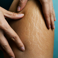 Vücutta çatlaklar neden olur, nasıl geçer?