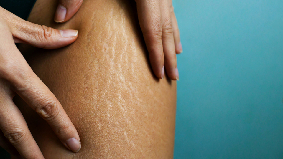 Vücutta çatlaklar neden olur, nasıl geçer?