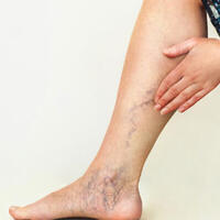 Varise iyi gelen doğal ve bitkisel çözümler