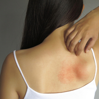 Sırtta sivilce neden çıkar, nasıl geçer?