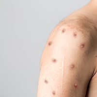 Sırttaki sivilcelere iyi doğal ve hızlı çözümler