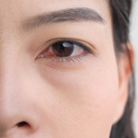 Göz kızarıklığı neden olur, nasıl geçer?