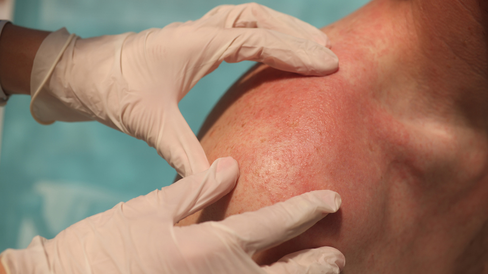 Güneş yanıklarına iyi gelen doğal çözümler