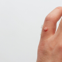 Eldeki siğil neden olur, nasıl geçer?