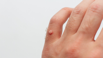 Eldeki siğil neden olur, nasıl geçer?