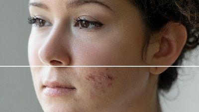 İltihaplı sivilce neden olur, nasıl geçer?