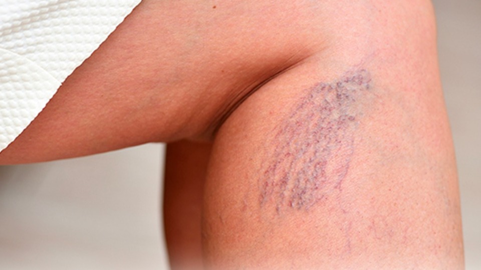 Varisi önlemek mümkün mü? Siz hangi gruptasınız?