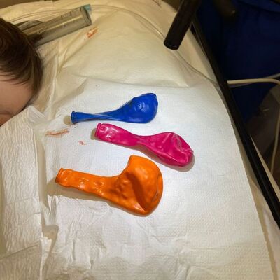 1 yaşındaki bebeğin midesinden 3 balon çıkarıldı!