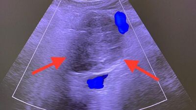 13 yıldır pankreas kanseriyle yaşıyor