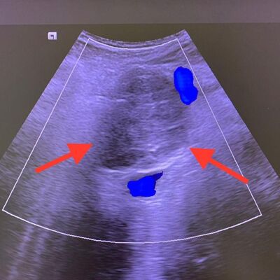 13 yıldır pankreas kanseriyle yaşıyor