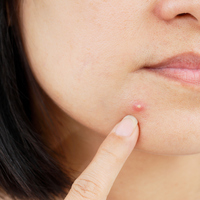 Sivilceli ciltler için doğal maske önerileri