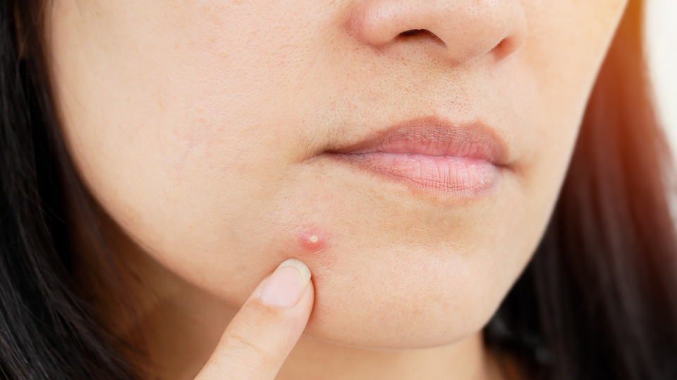 Sivilceli ciltler için doğal maske önerileri