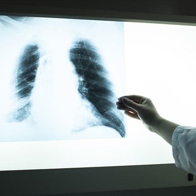 DSÖ'den tüberküloz açıklaması!