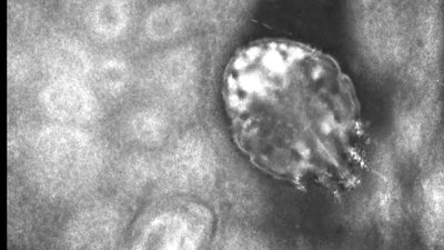 Dirençli uyuz salgını açıklaması!