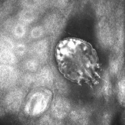 Dirençli uyuz salgını açıklaması!